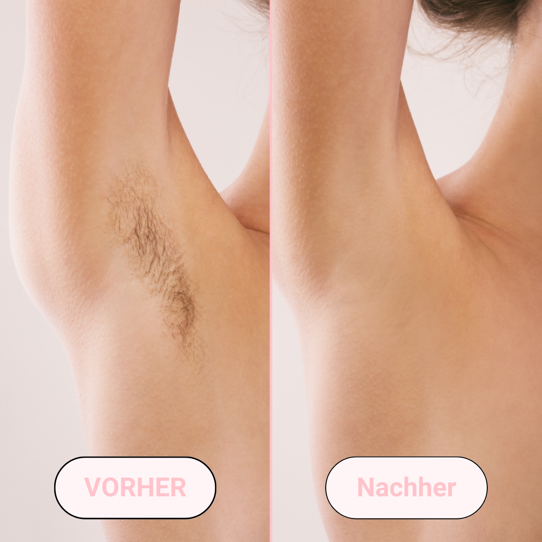 Removely IPL 5+ (inkl. Summer Sale Geschenk)