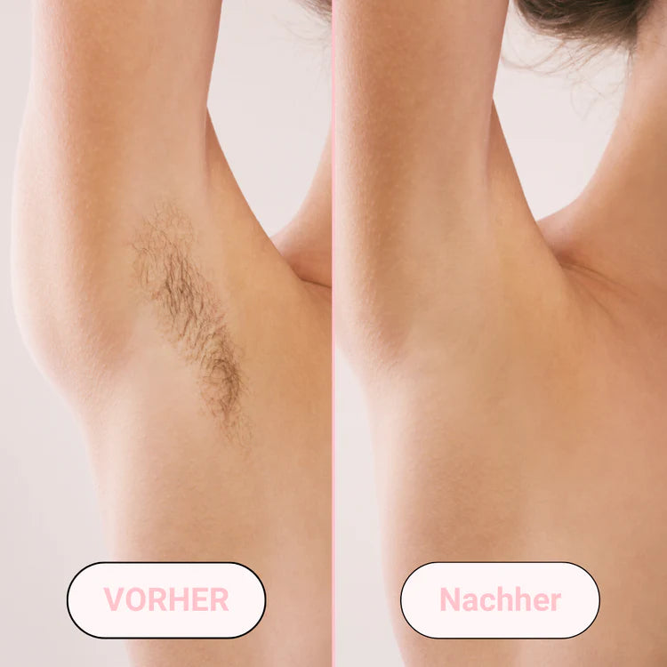 Removely IPL 3+ (Try & Buy)