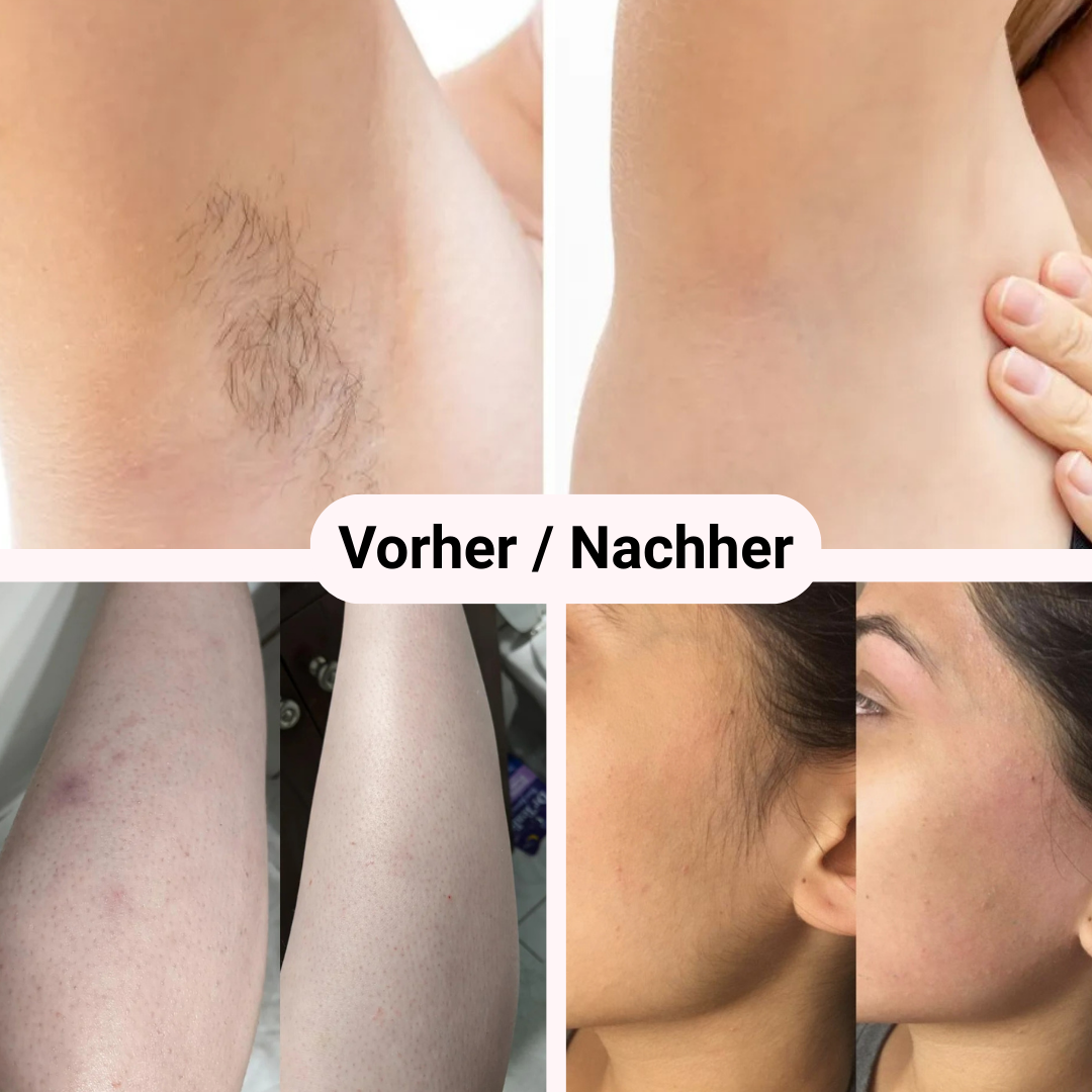 Removely IPL 3+ (Try & Buy)